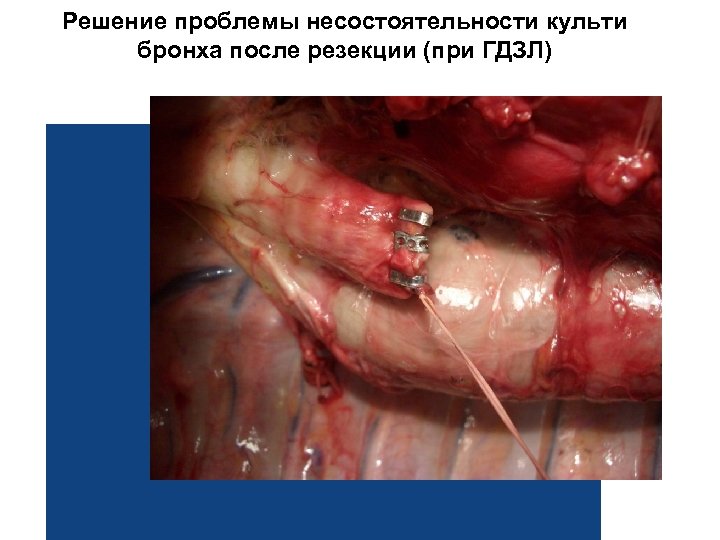 Решение проблемы несостоятельности культи бронха после резекции (при ГДЗЛ) 