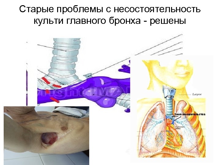 Старые проблемы с несостоятельность культи главного бронха - решены 