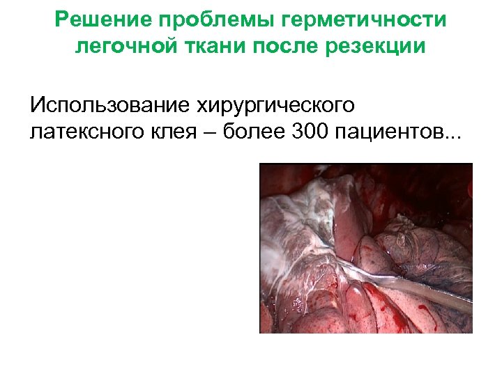 Решение проблемы герметичности легочной ткани после резекции Использование хирургического латексного клея – более 300