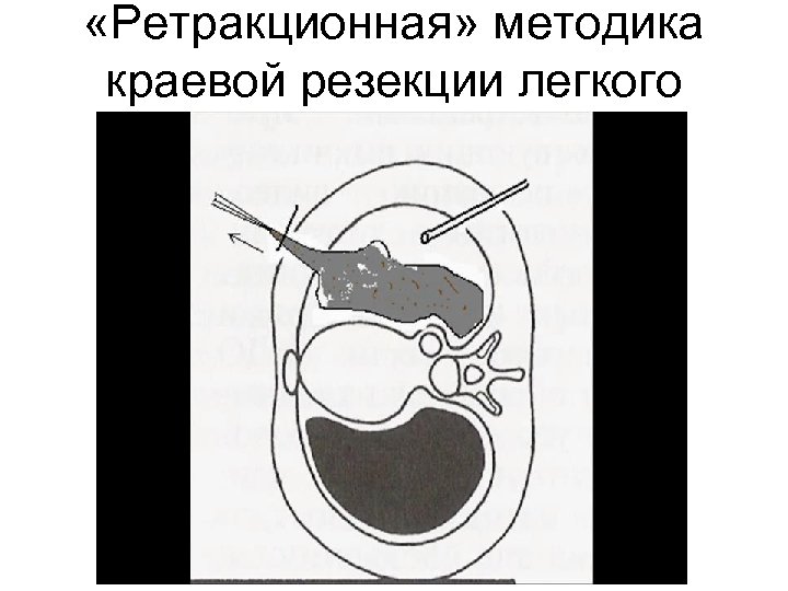 «Ретракционная» методика краевой резекции легкого 
