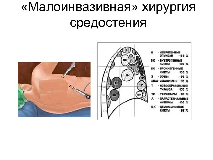 «Малоинвазивная» хирургия средостения 
