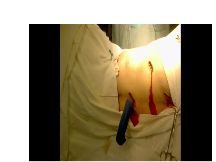 Торакоскопия при травме грудной клетки 