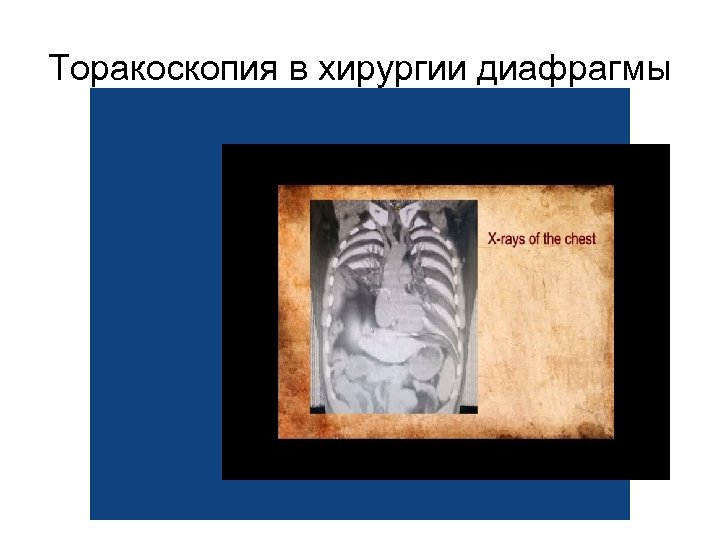Торакоскопия в хирургии диафрагмы 