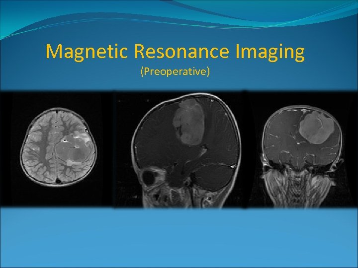 Magnetic Resonance Imaging (Preoperative) 