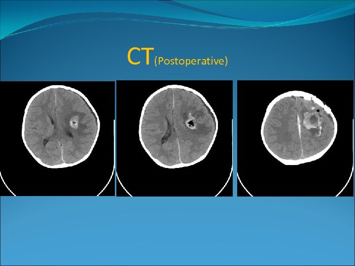 CT(Postoperative) 