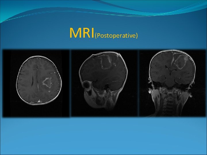 MRI(Postoperative) 