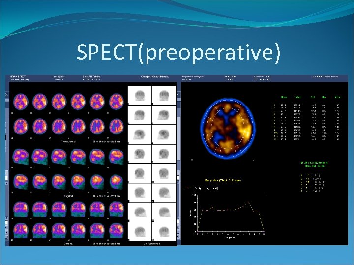 SPECT(preoperative) 