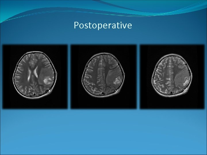 Postoperative 