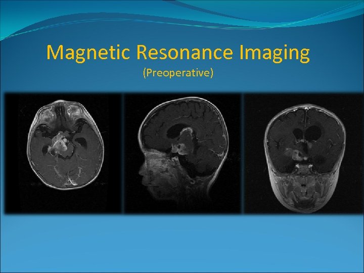 Magnetic Resonance Imaging (Preoperative) 