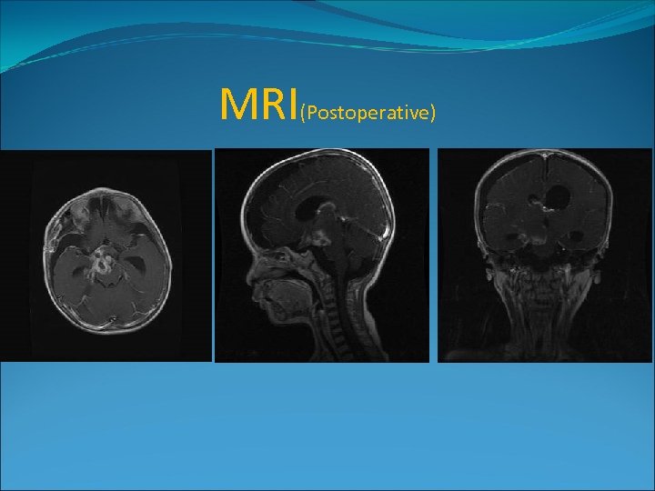 MRI(Postoperative) 