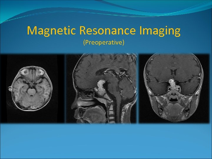 Magnetic Resonance Imaging (Preoperative) 