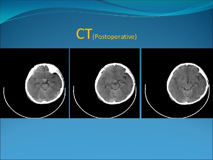 CT(Postoperative) 