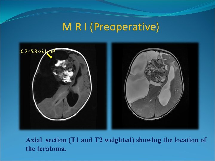 M R I (Preoperative) 6. 2× 5. 8× 6. 1 cm 3 Axial section