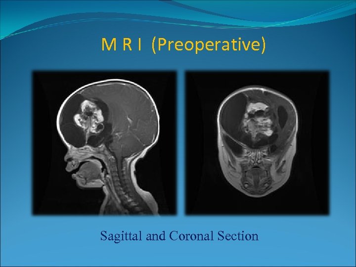 M R I (Preoperative) Sagittal and Coronal Section 