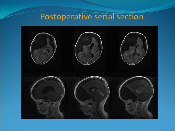 Postoperative serial section 