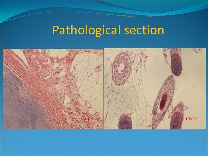 Pathological section HE× 100 