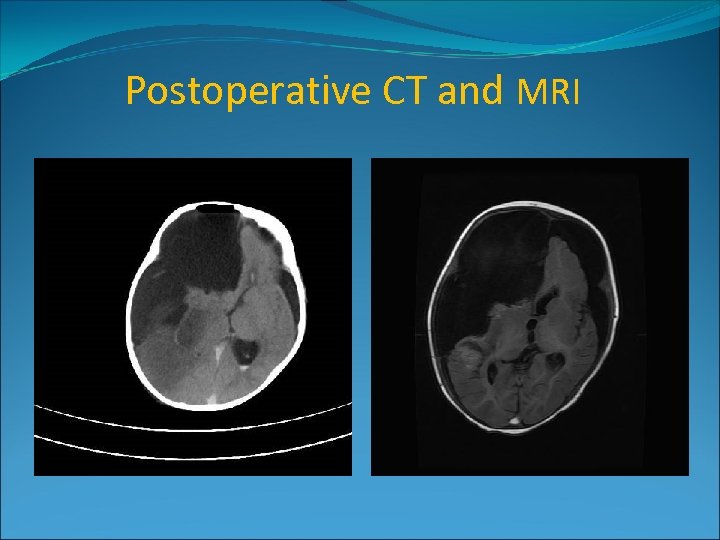 Postoperative CT and MRI 