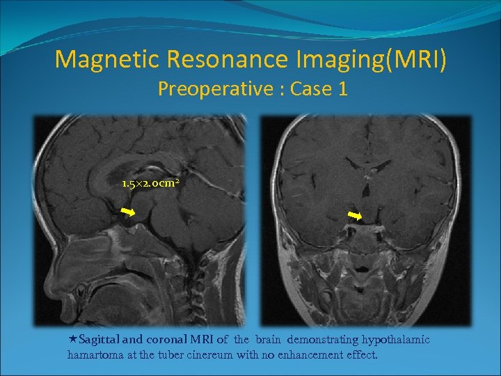 Magnetic Resonance Imaging(MRI) Preoperative : Case 1 1. 5× 2. 0 cm 2 Sagittal