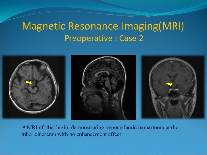 Magnetic Resonance Imaging(MRI) Preoperative : Case 2 2× 3 cm 2 MRI of the