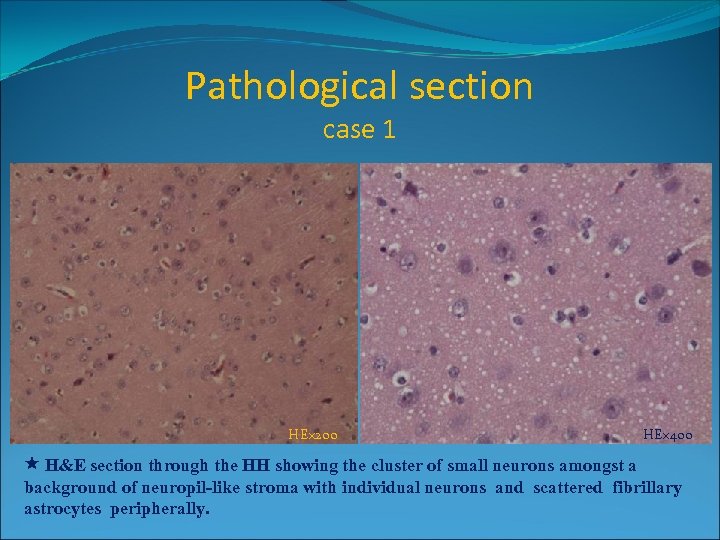 Pathological section case 1 HE× 200 HE× 400 H&E section through the HH showing