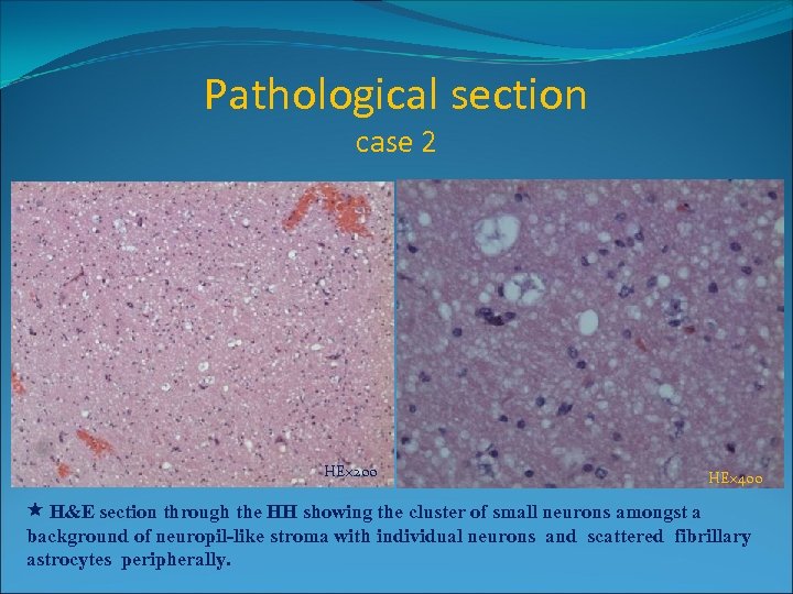 Pathological section case 2 HE× 200 HE× 400 H&E section through the HH showing