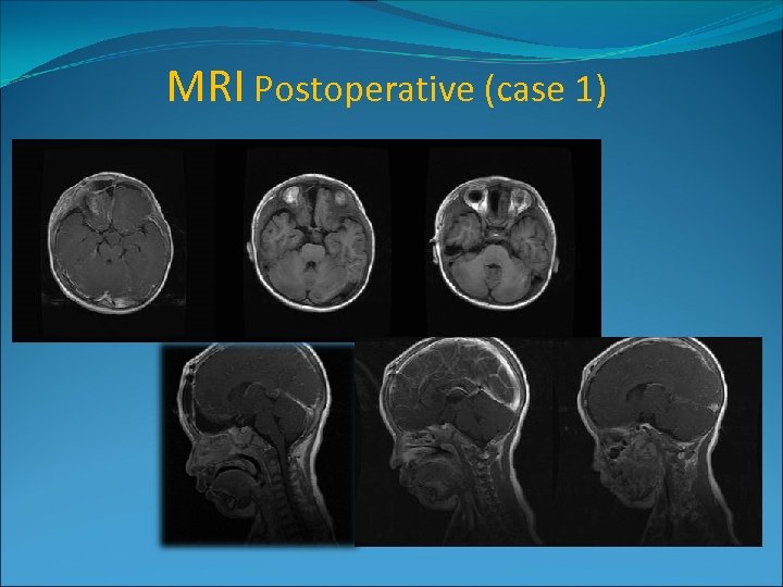 MRI Postoperative (case 1) 