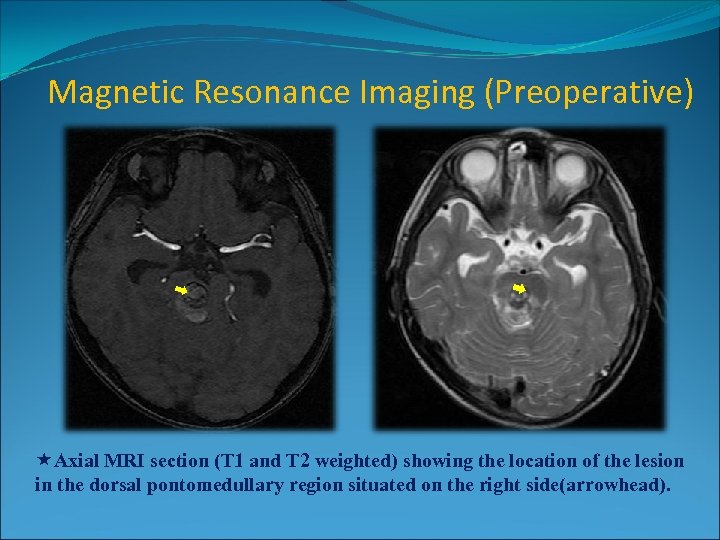 Magnetic Resonance Imaging (Preoperative) Axial MRI section (T 1 and T 2 weighted) showing