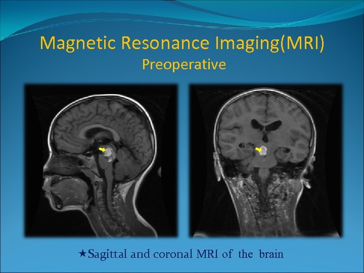 Magnetic Resonance Imaging(MRI) Preoperative Sagittal and coronal MRI of the brain 