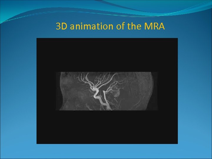 3 D animation of the MRA 