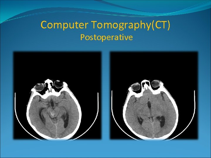 Computer Tomography(CT) Postoperative 