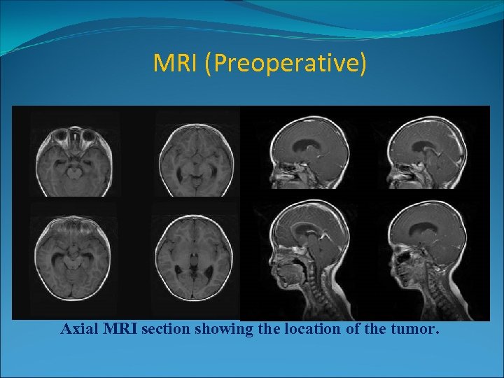 MRI (Preoperative) 3. 8× 1. 8× 2. 4 cm 3 Axial MRI section showing