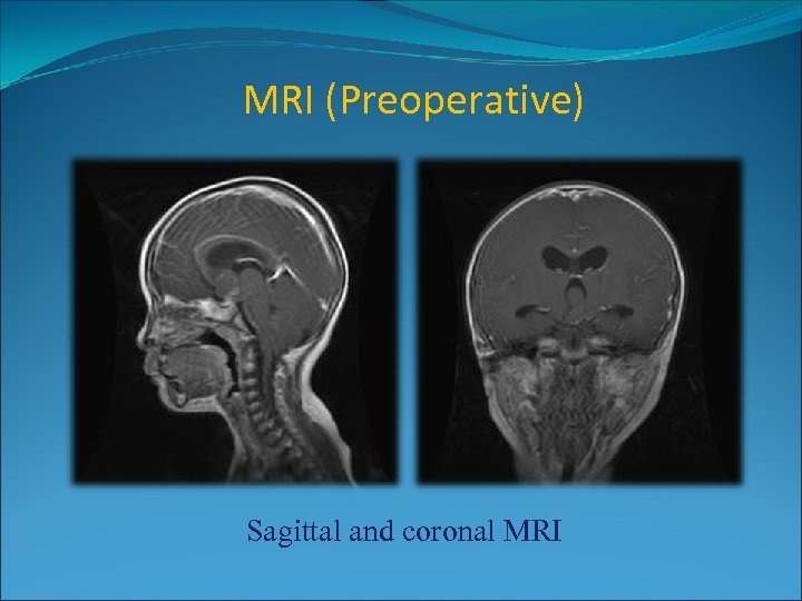 MRI (Preoperative) Sagittal and coronal MRI 