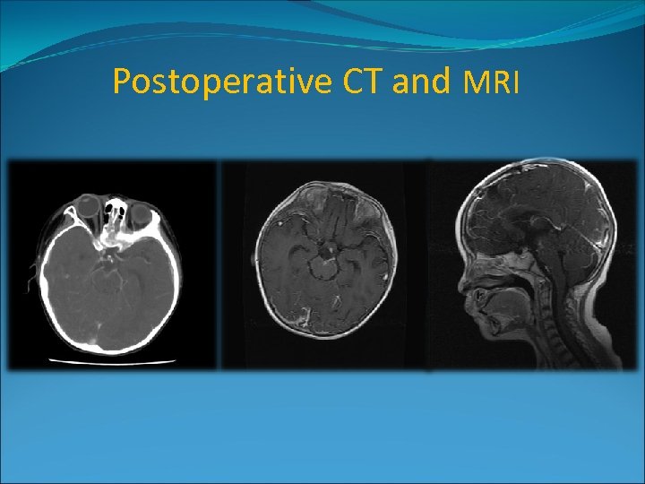 Postoperative CT and MRI 