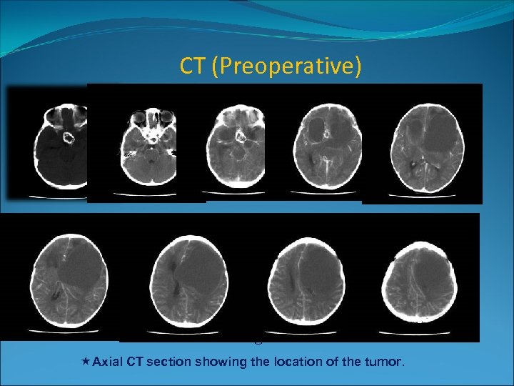 CT (Preoperative) 5× 4× 5 cm 3 Axial CT section showing the location of