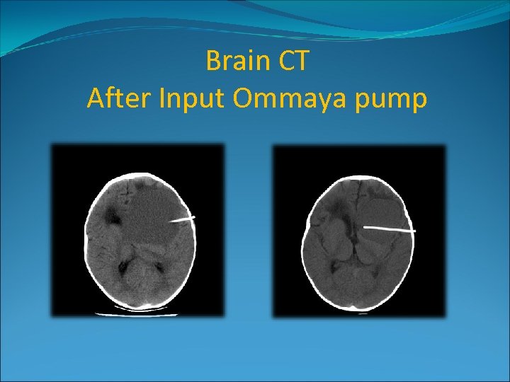 Brain CT After Input Ommaya pump 