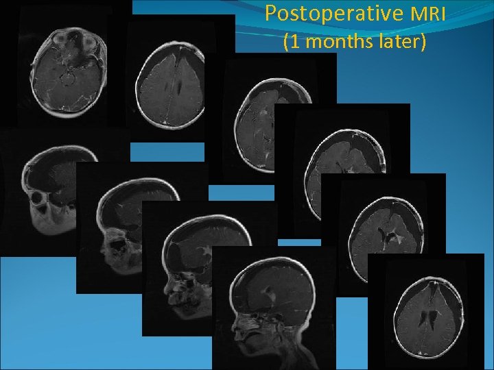 Postoperative MRI (1 months later) 