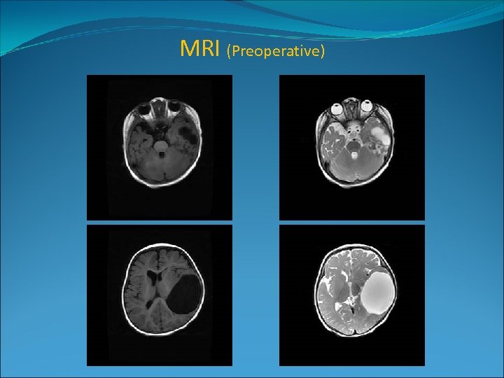 MRI (Preoperative) 