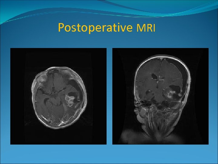 Postoperative MRI 