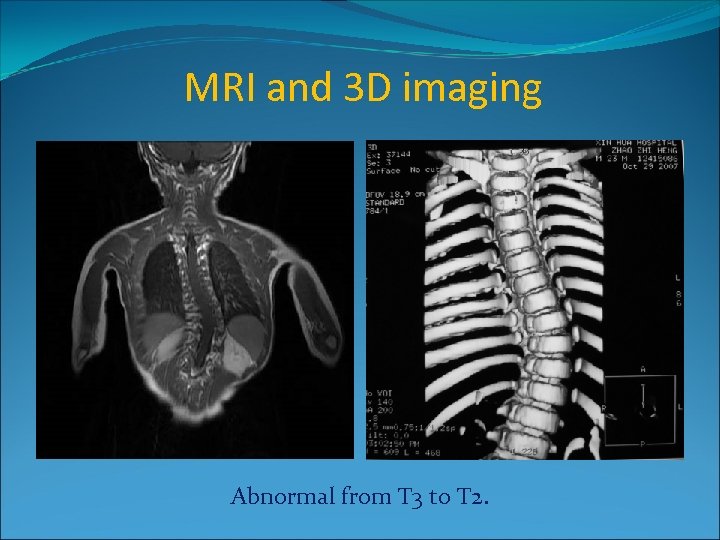 MRI and 3 D imaging Abnormal from T 3 to T 2. 