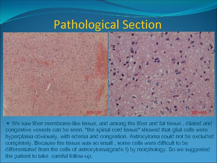 Pathological Section HE× 100 HE× 400 We saw fiber membrane-like tissue, and among the