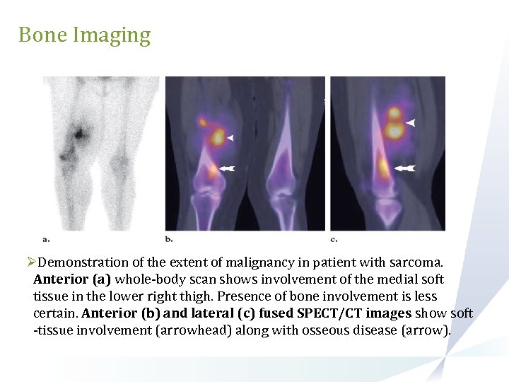 Bone Imaging ØDemonstration of the extent of malignancy in patient with sarcoma. Anterior (a)