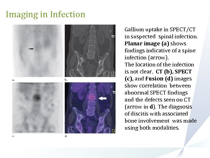 Imaging in Infection Gallium uptake in SPECT/CT in suspected spinal infection. Planar image (a)