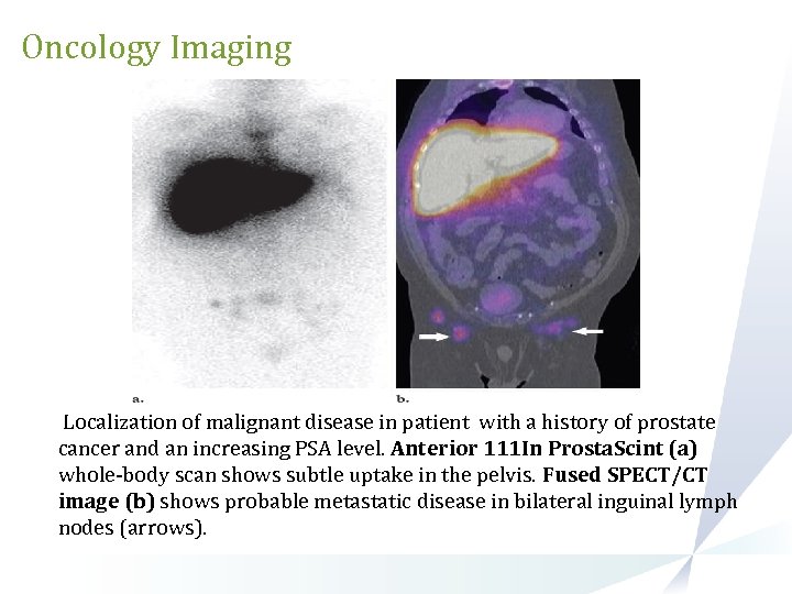 Oncology Imaging Localization of malignant disease in patient with a history of prostate cancer