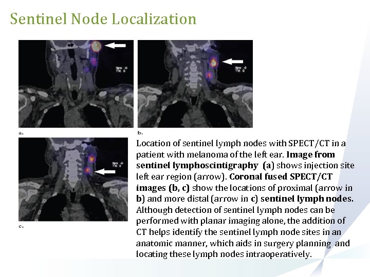 Sentinel Node Localization Location of sentinel lymph nodes with SPECT/CT in a patient with