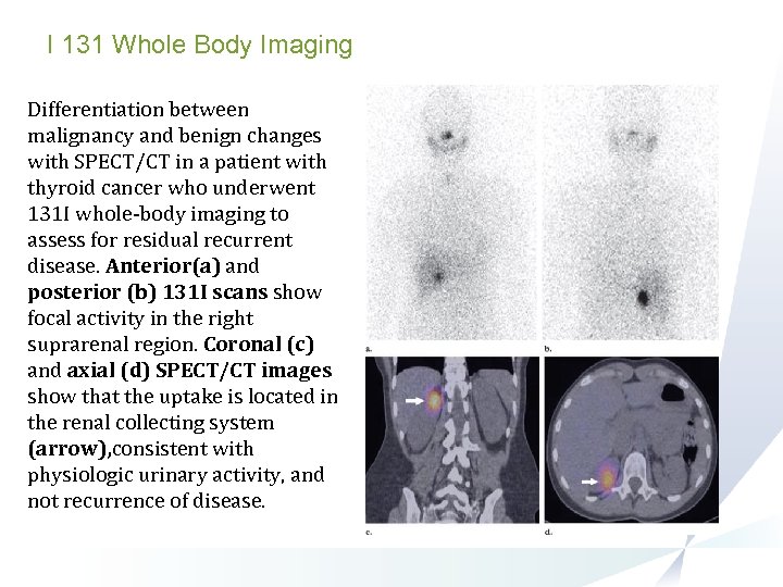 I 131 Whole Body Imaging Differentiation between malignancy and benign changes with SPECT/CT in