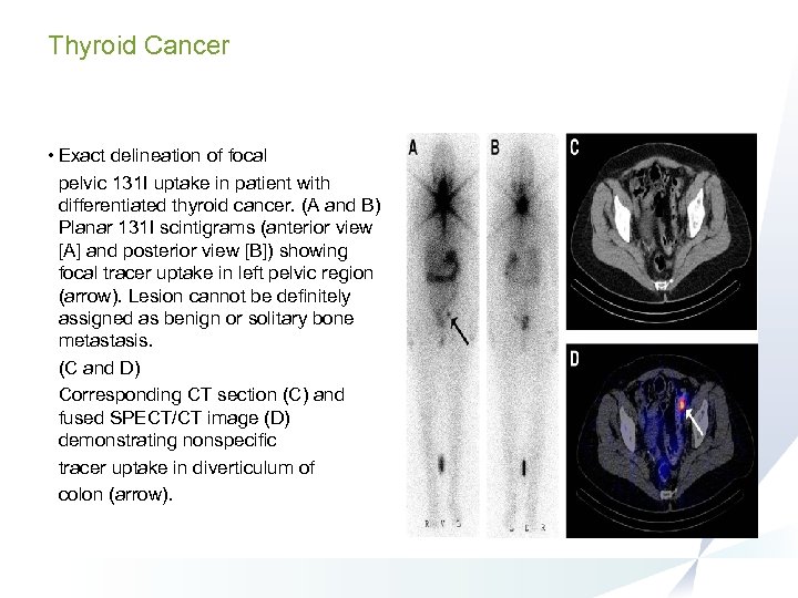 Thyroid Cancer • Exact delineation of focal pelvic 131 I uptake in patient with