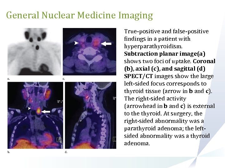 General Nuclear Medicine Imaging True-positive and false-positive findings in a patient with hyperparathyroidism. Subtraction