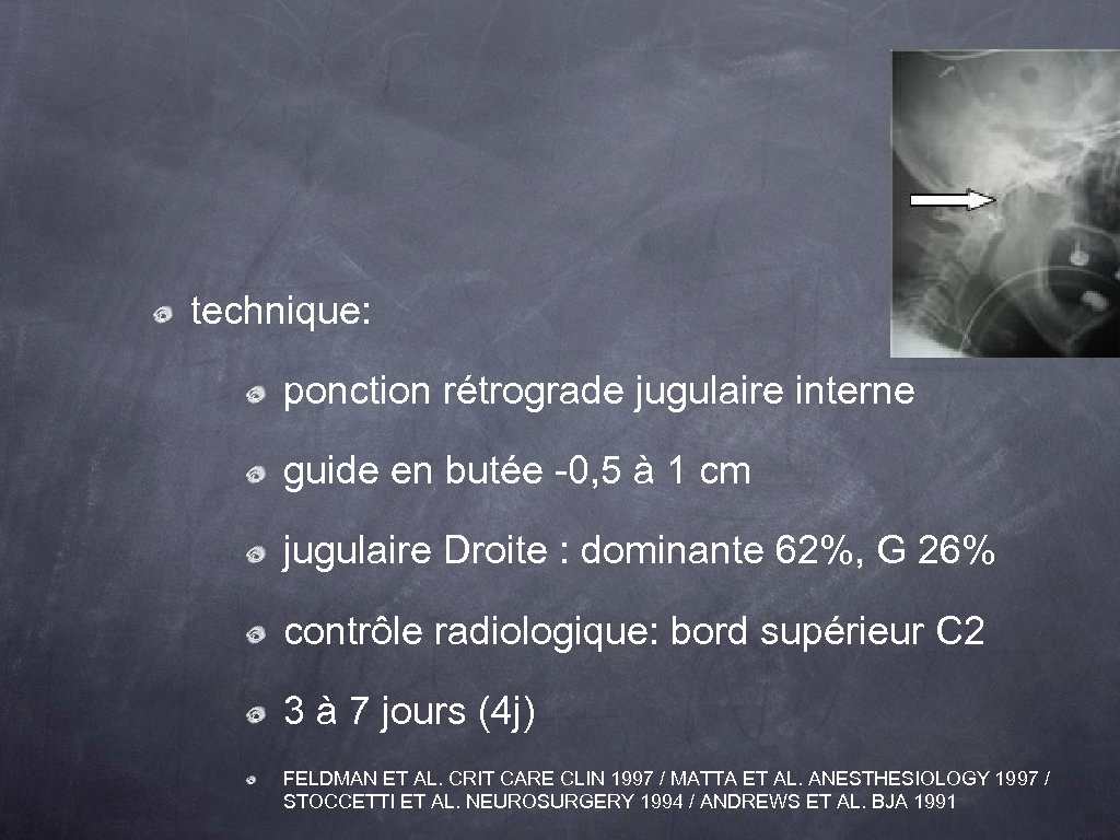 technique: ponction rétrograde jugulaire interne guide en butée -0, 5 à 1 cm jugulaire