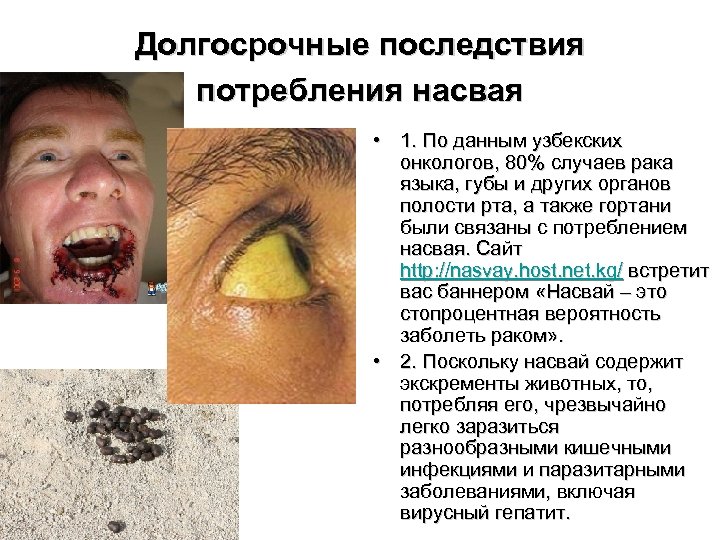 Долгосрочные последствия потребления насвая • 1. По данным узбекских онкологов, 80% случаев рака языка,