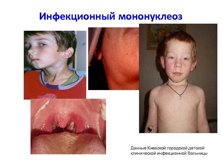 Инфекционный мононуклеоз Данные Киевской городской детской клинической инфекционной больницы 